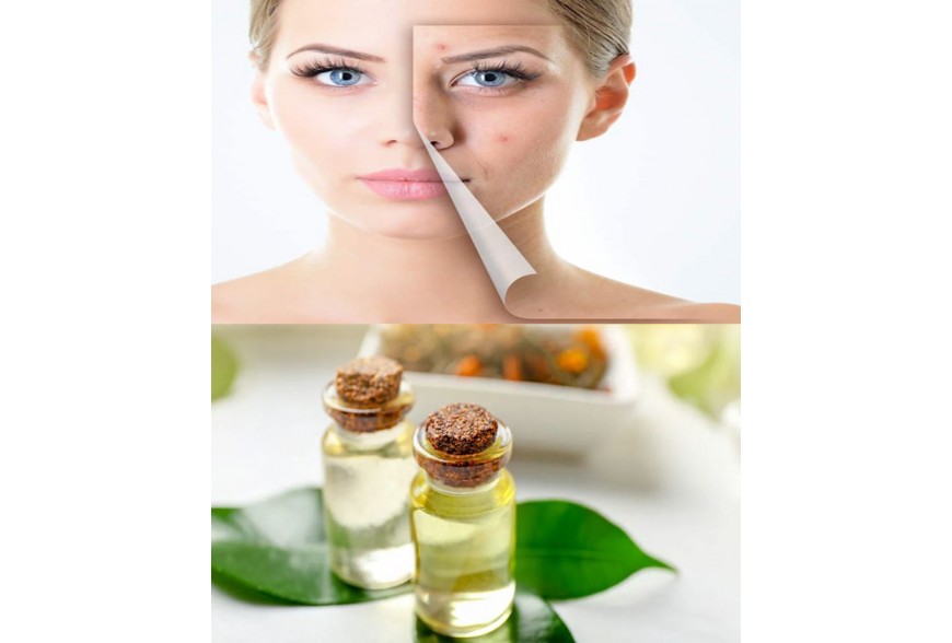 Huiles naturelles et remèdes naturels efficaces pour traiter l'acné et se débarrasser de ses effets
